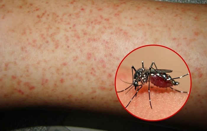 Đừng chủ quan với dịch sốt xuất huyết có nguy cơ bùng phát mạnh trong thời điểm này - Ảnh 3.