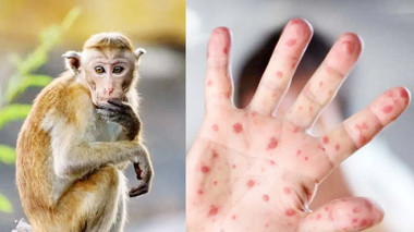 Phát hiện ca nghi mắc đậu mùa khỉ đầu tiên: Chủ động biện pháp ứng phó